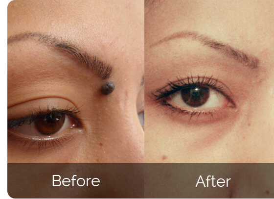Skin Tag Wellness Remover Serum